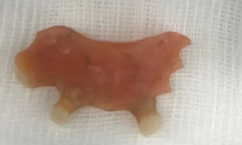 Người phụ nữ được nội soi lấy cung răng trong thực quản 